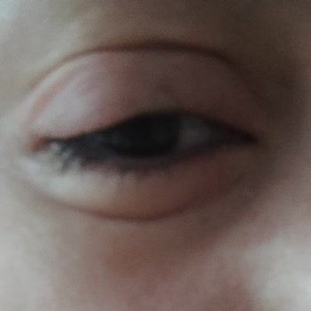 İsana Temizleme Jelinin Gözde Şişlik Ve Kızarıklığa Yol Açması