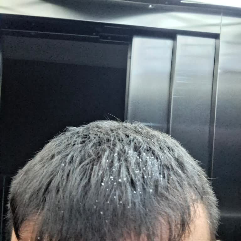 Clear Şampuanı Saçlarımda Aşırı Kepek Oluşturdu, Değişim Ve Açıklama İstiyorum