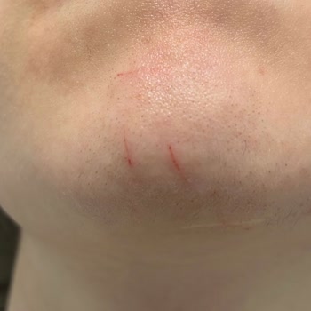 By Tuğçe Akman Güzellik Merkezi Lazer Epilasyon İşlemi Sırasında Yüzüm Kesildi