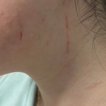 By Tuğçe Akman Güzellik Merkezi Lazer Epilasyon İşlemi Sırasında Yüzüm Kesildi