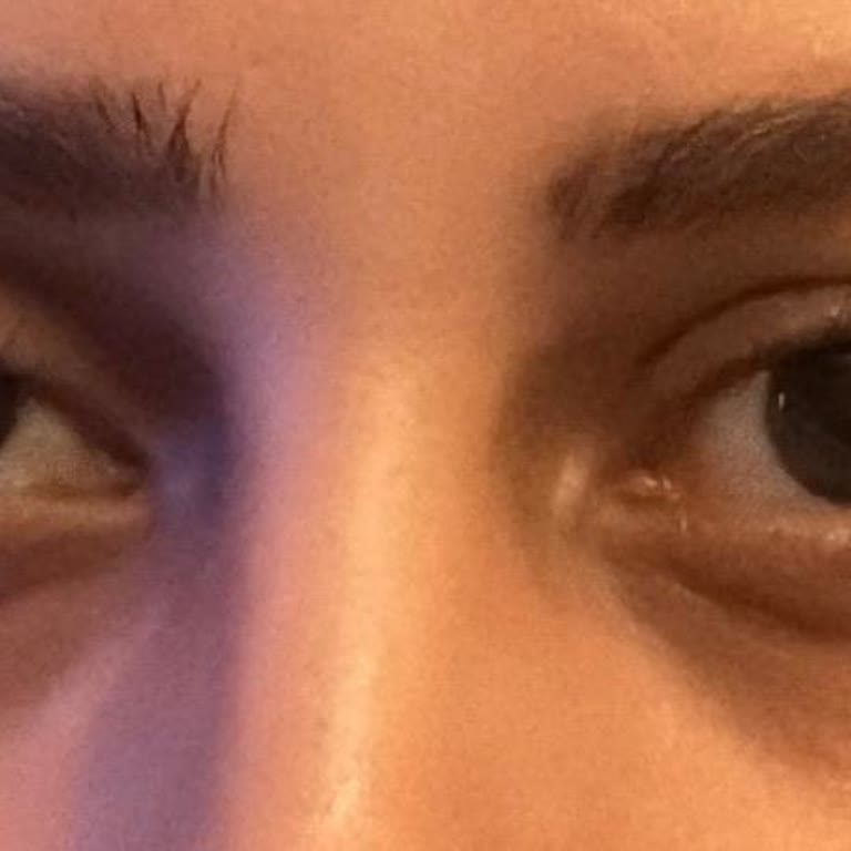 İstanbul Dolgu Botox Kaş Düşüklüğü Ve Takip İhmaline Şikayet