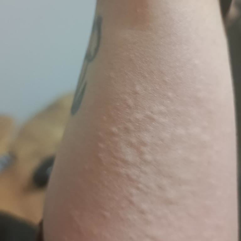 Sinoz Glow Tonik Şiddetli Alerjik Reaksiyon Ve İade Talebi