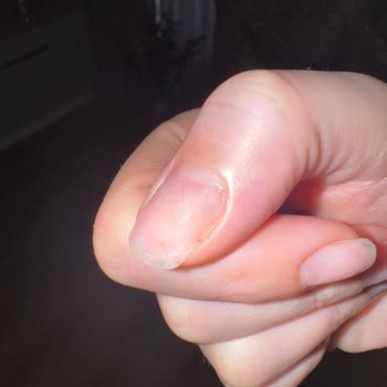 Emsal Doğan Güzellik Merkezi Kalıcı Oje Çıkarma İşleminde Şiddetli Acı Ve Tırnak Zedelenmesi