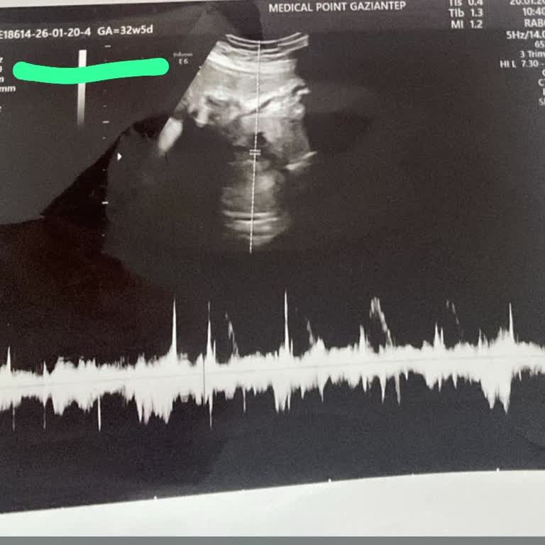 Gebelik Sürecindeki Provizyon Redleri Ve Sigorta Mağduriyeti