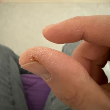 Activex Antibakteriyel Sabun Hassas Ciltlerde Yanma Ve Çatlaklara Neden Oldu