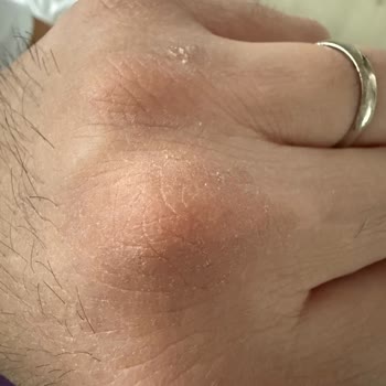 Activex Antibakteriyel Sabun Hassas Ciltlerde Yanma Ve Çatlaklara Neden Oldu