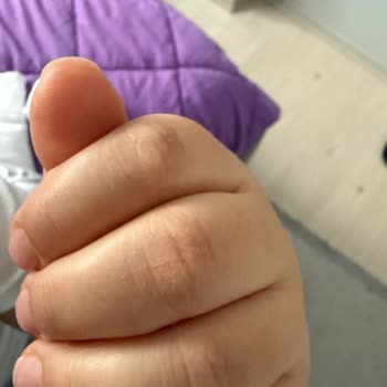 Activex Antibakteriyel Sabun Hassas Ciltlerde Yanma Ve Çatlaklara Neden Oldu