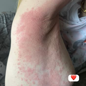 Old Spice Captain Deodorant Jelinde Ağır Alerjik Reaksiyon Ve Dermatit