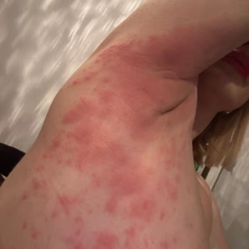 Old Spice Captain Deodorant Jelinde Ağır Alerjik Reaksiyon Ve Dermatit