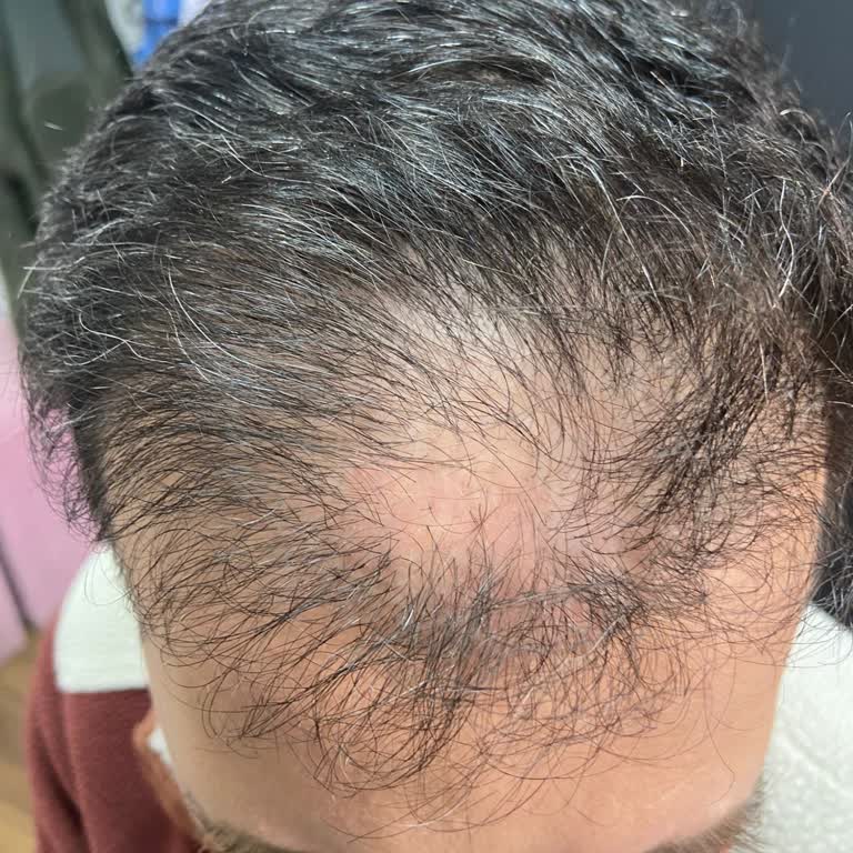 Saç Ekimi Sonrası İletişimsizlik Ve Takip Eksikliği