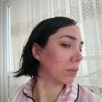 Sebamed Şampuanı Cildimde Şiddetli Yanma Ve Kızarıklığa Neden Oldu