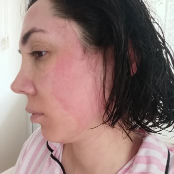 Sebamed Şampuanı Cildimde Şiddetli Yanma Ve Kızarıklığa Neden Oldu