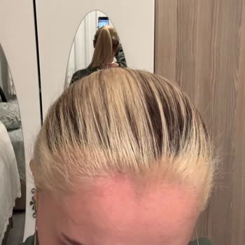 Mamak'ta Kuaförde Ombre İşlemi Sonrası Saç Yanığı Ve Aşırı Ücret