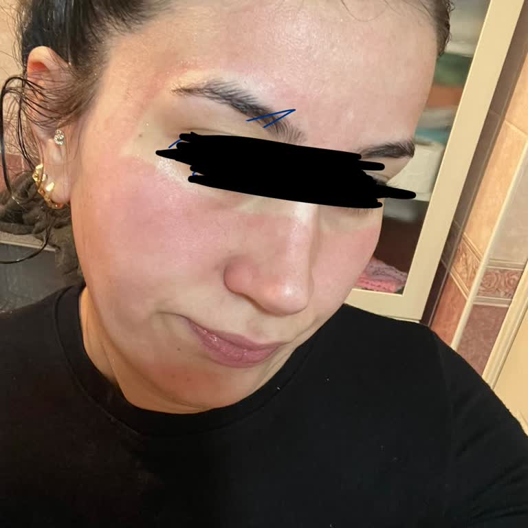 Şiddetli Yanma Ve Kızarıklık: Neutrogena Peeling Jelinde Alerjik Reaksiyon