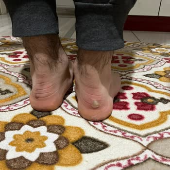 Reebok Ayakkabısının Topuk Deformasyonu Ve Enfeksiyon Nedeniyle Sağlık Sorunu Ve İade Talebi