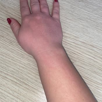 Alerjik Reaksiyon Nedeniyle Bayer İlacı İadesi Ve Ücret Geri Ödemesi Talebi!