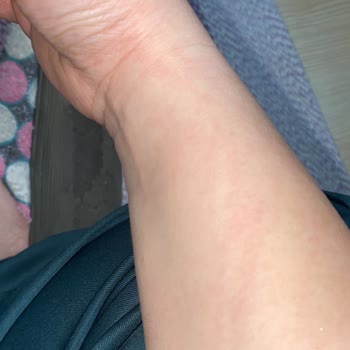 Alerjik Reaksiyon Nedeniyle Bayer İlacı İadesi Ve Ücret Geri Ödemesi Talebi!