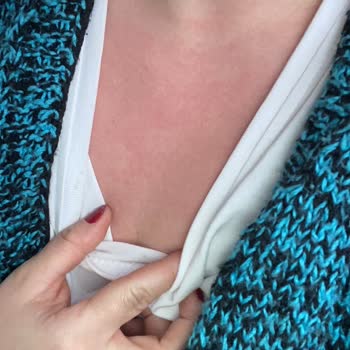 Alerjik Reaksiyon Nedeniyle Bayer İlacı İadesi Ve Ücret Geri Ödemesi Talebi!