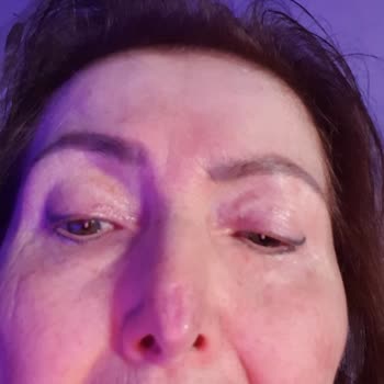 İzmir Ekol Hastanesi'nde Burun Estetiği Sonrası Cadı Burnu Ve Tekrarlanan Ameliyat Hataları