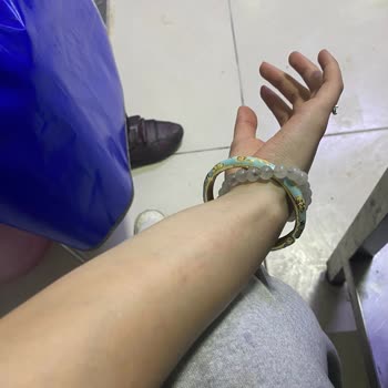 Lazer Epilasyon Sonrası Yanık Ve İz Sorunu İçin Sorumluluk Talebi