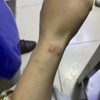 Lazer Epilasyon Sonrası Yanık Ve İz Sorunu İçin Sorumluluk Talebi