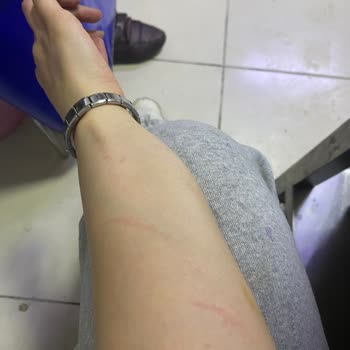 Lazer Epilasyon Sonrası Yanık Ve İz Sorunu İçin Sorumluluk Talebi