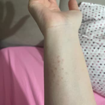 Bingo Sensitive Deterjanı Ciltte Egzama Benzeri Kızarıklık Ve Kaşıntıya Sebep Oldu