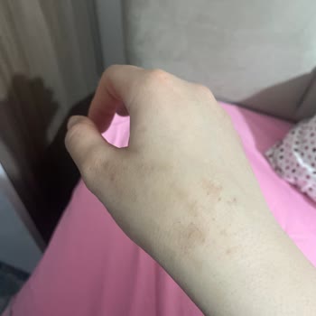 Bingo Sensitive Deterjanı Ciltte Egzama Benzeri Kızarıklık Ve Kaşıntıya Sebep Oldu