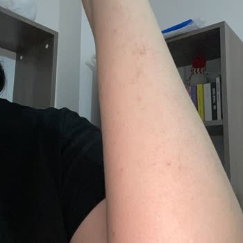 Bingo Sensitive Deterjanı Ciltte Egzama Benzeri Kızarıklık Ve Kaşıntıya Sebep Oldu