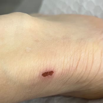 Ayakkabının Üretim Hatası Yara Açtı, Müşteri Hizmetleri Çözüm Sunmadı