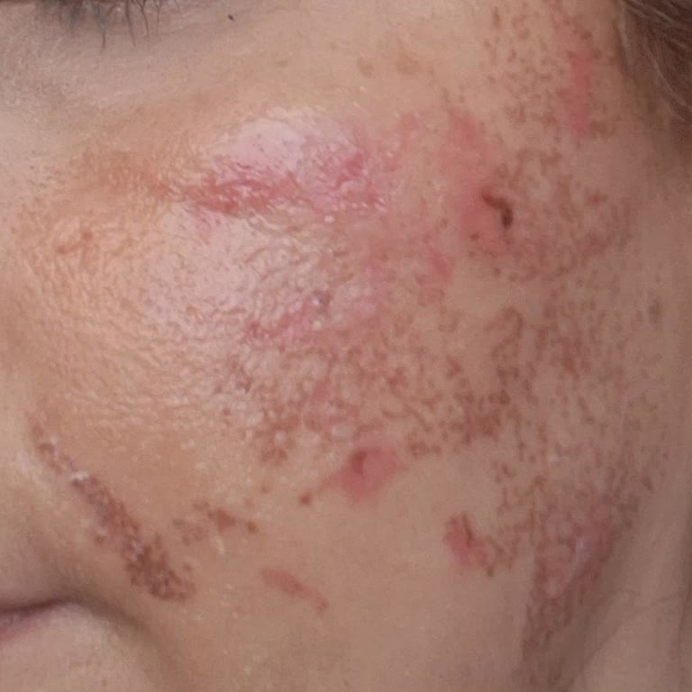 Avis Vip Şubesinde Arc Leke İşlemi Sonrası Yanık Ve Geri Ödeme Talebi