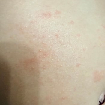 Bebek Cildinde Kızarıklık Ve Döküntü: Mustela Stelatopia İade Talebi