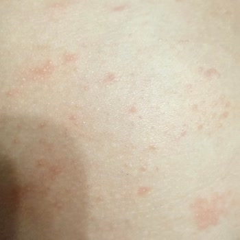 Bebek Cildinde Kızarıklık Ve Döküntü: Mustela Stelatopia İade Talebi