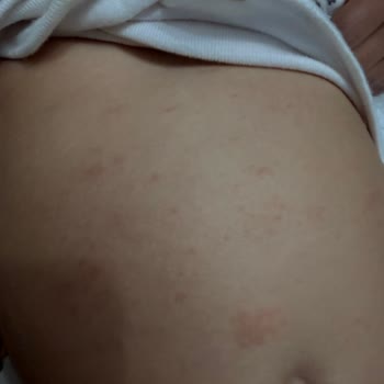 Bebek Cildinde Kızarıklık Ve Döküntü: Mustela Stelatopia İade Talebi