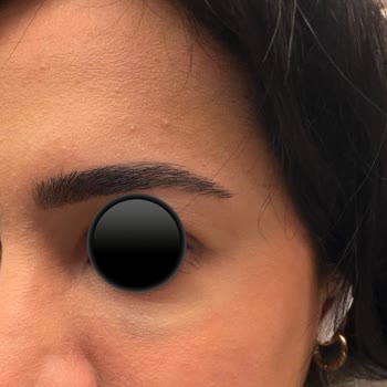 Op Dr Evren Helvacı Göz Altı Dolgusu Sonrası Morarma Ve İade Talebi