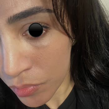 Op Dr Evren Helvacı Göz Altı Dolgusu Sonrası Morarma Ve İade Talebi