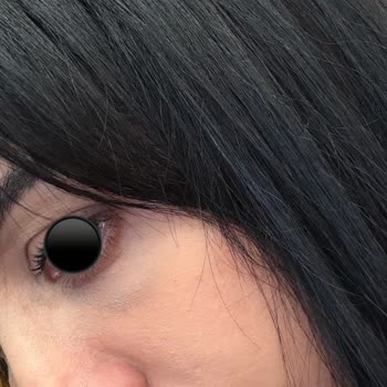 Op Dr Evren Helvacı Göz Altı Dolgusu Sonrası Morarma Ve İade Talebi