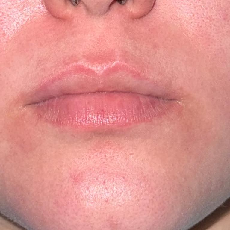 Bebek Şampuanı Cilt Tahrişi Ve Şiddetli Şişlik