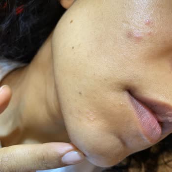 Caudalie Leke Karşıtı Serumu Sivilcelenmeye Neden Oldu Ve Ücret İadesi Talep Ediliyor