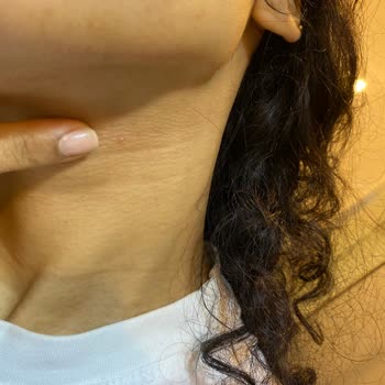 Caudalie Leke Karşıtı Serumu Sivilcelenmeye Neden Oldu Ve Ücret İadesi Talep Ediliyor