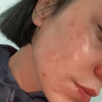 Calliel Rice Milk Tonik Kullanımından Şiddetli Yanma Ve Yara Oluşumu, İnceleme Ve Tazminat Talebi