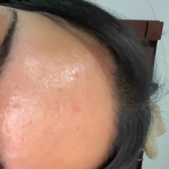 Calliel Rice Milk Tonik Kullanımından Şiddetli Yanma Ve Yara Oluşumu, İnceleme Ve Tazminat Talebi