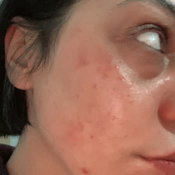 Calliel Rice Milk Tonik Kullanımından Şiddetli Yanma Ve Yara Oluşumu, İnceleme Ve Tazminat Talebi