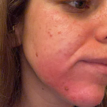 Yade Güzellik | Bodrum Yosun Peeling Yapıp Yüzümün Yanmasına Neden Oldular!