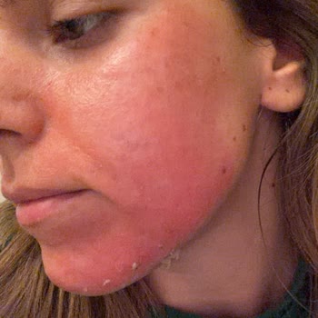 Yade Güzellik | Bodrum Yosun Peeling Yapıp Yüzümün Yanmasına Neden Oldular!