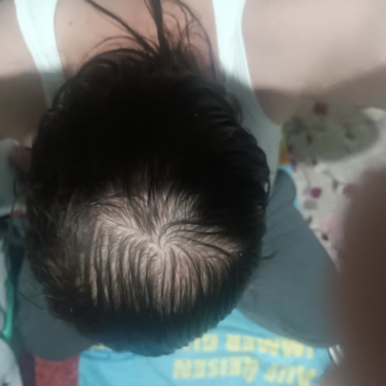 Motto Saç Ürünleri Saç Dökülmesi Ve Yıpranmasına Neden Oldu