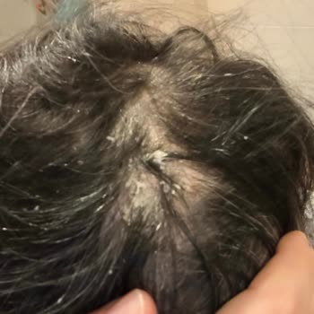 Gliss Ürünleri Saç Dökülmesi Ve Şiddetli Alerjik Reaksiyon Yaratıyor, Yetkiliye Ulaşılamıyor