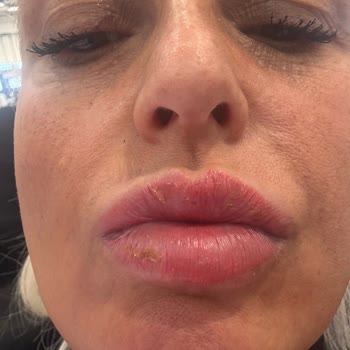İki Deneme Sonrası Dudak Renklendirme Hatası Ve İade Talebi