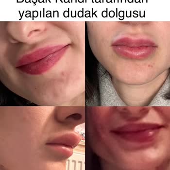 Prof Dr. Başak Kandi Dudak Dolgusunda Mağdur Etti Telafi Etmedi