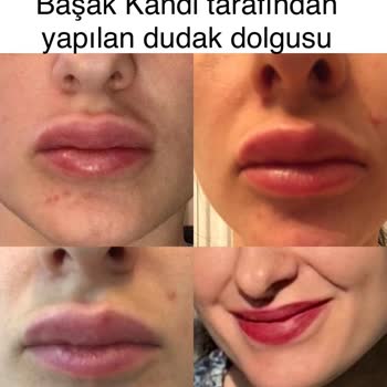 Prof Dr. Başak Kandi Dudak Dolgusunda Mağdur Etti Telafi Etmedi